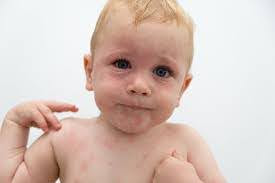 Allergy-in-baby