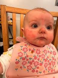 Food-allergy-in-infants