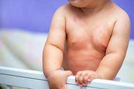 Signs-of-allergy-in-infany
