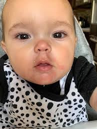 allergic-reaction-in-infants